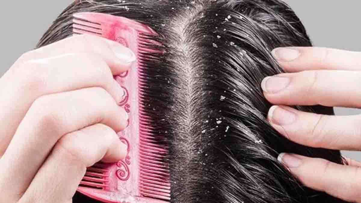 Ways to get rid of dandruff : डैंड्रफ से हो गए हैं परेशान तो तुरंत आजमाएं यह आसान और प्रभावी घरेलू उपाय