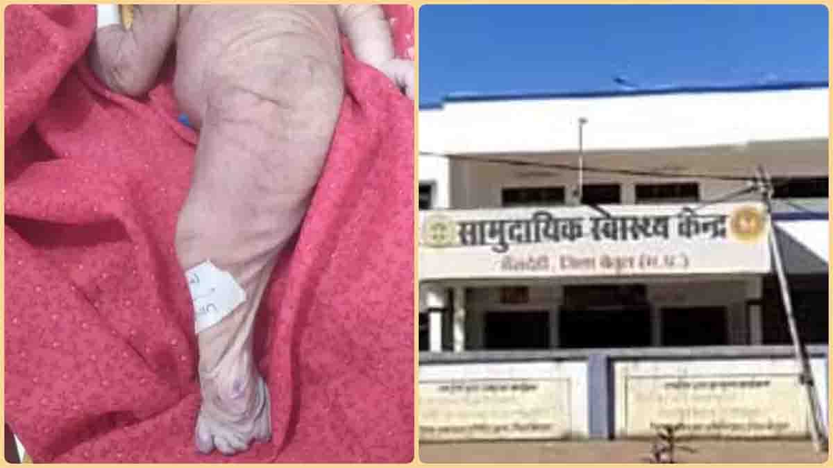 Mermaid syndrome : जलपरी जैसे चिपके पांव वाले बच्चे का हुआ जन्म, कुछ घंटों बाद ही तोड़ दिया दम